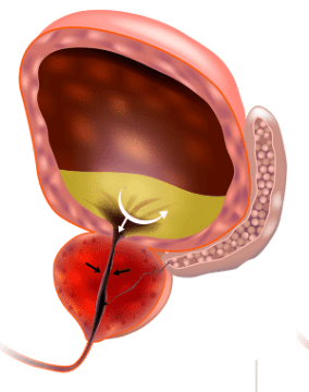 early-stage-enlarged-prostate-partially-blocking-the-urethra