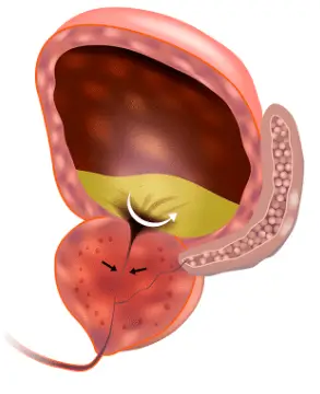 late-stage-prostate-enlargement-causing-significant-urinary-obstruction